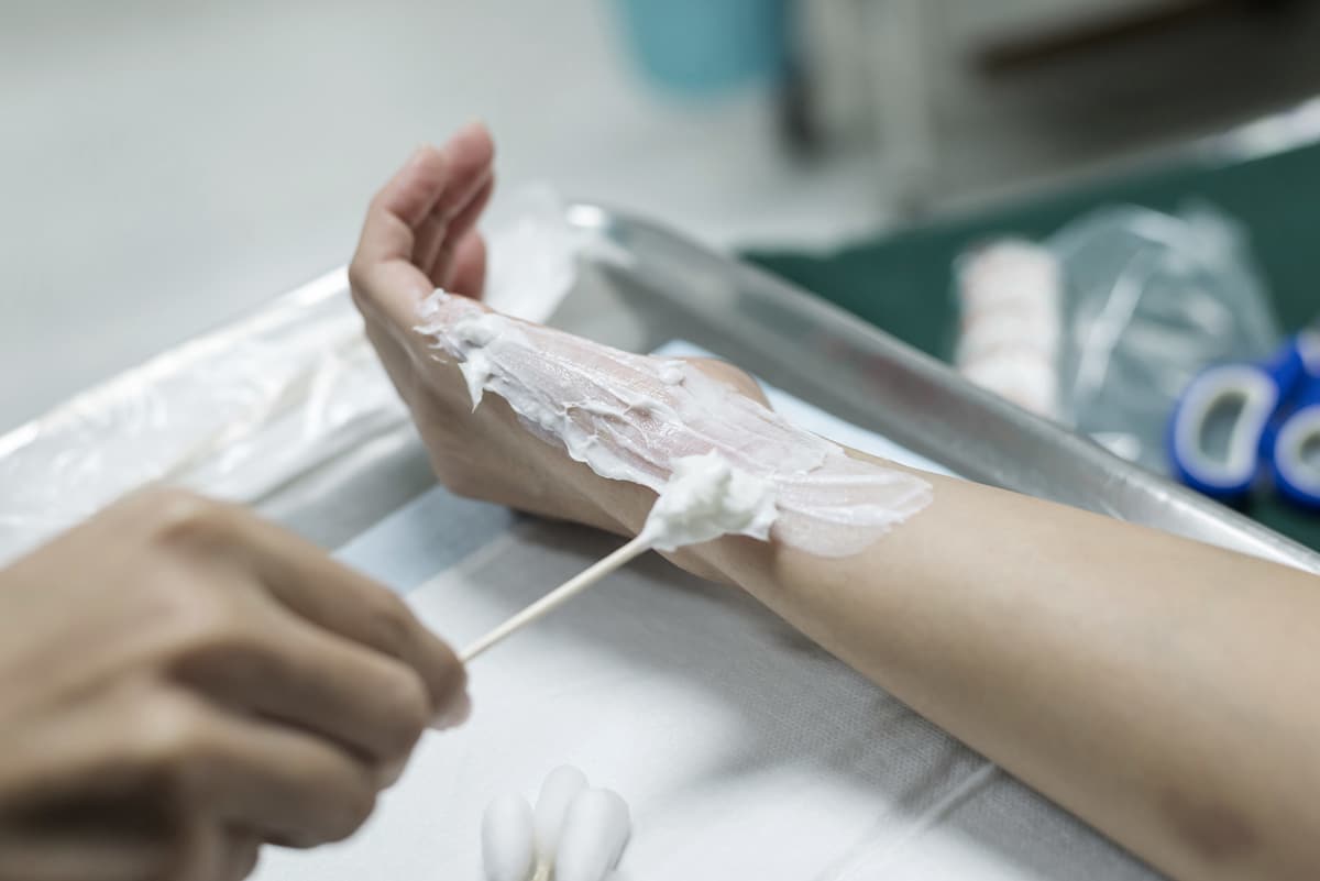 cream thickly applied to hand burn