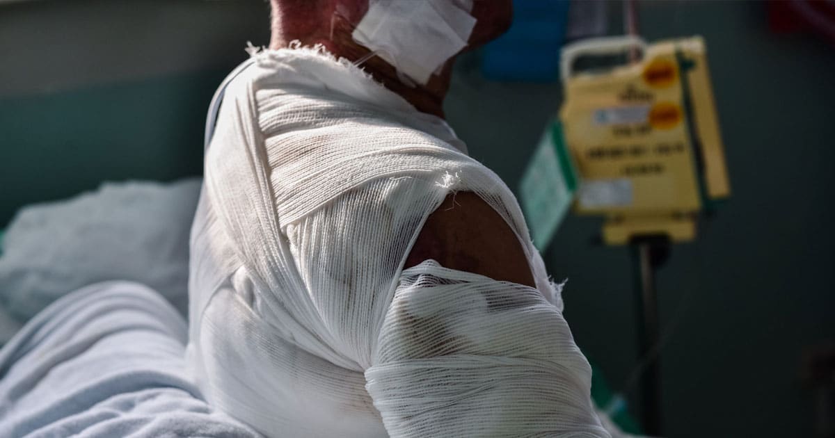 How Common Are Burn Injuries in NY?