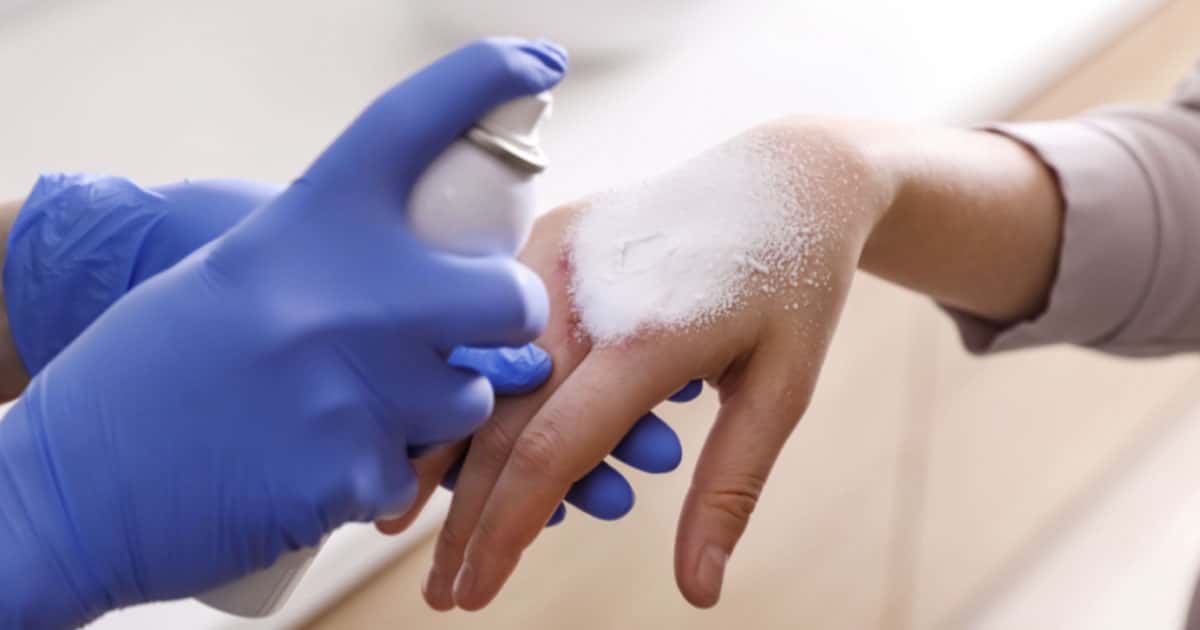 Medical Treatment for Burn Injuries In NYC