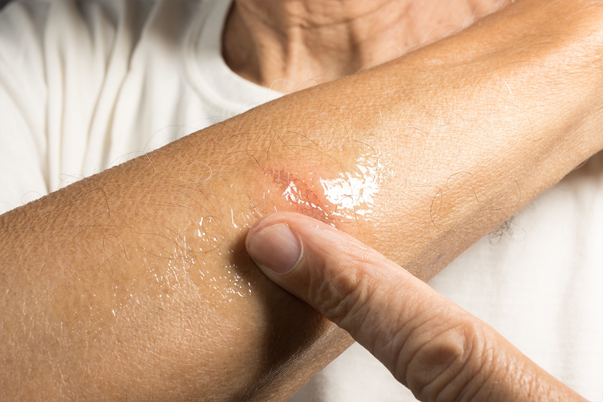Treatments for Minor to Moderate Burns