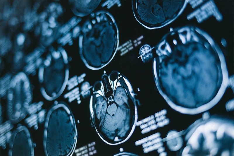 Traumatic Brain Injuries (TBIs)​