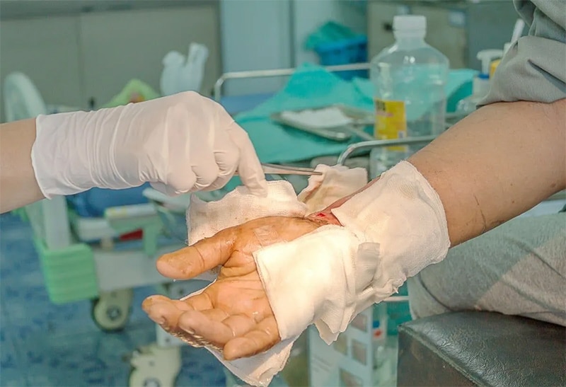 Definition of Burn Injury Fresno CA