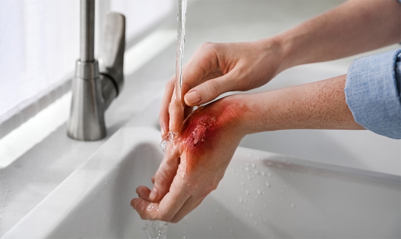 Causes of Burn Injuries in Fresno