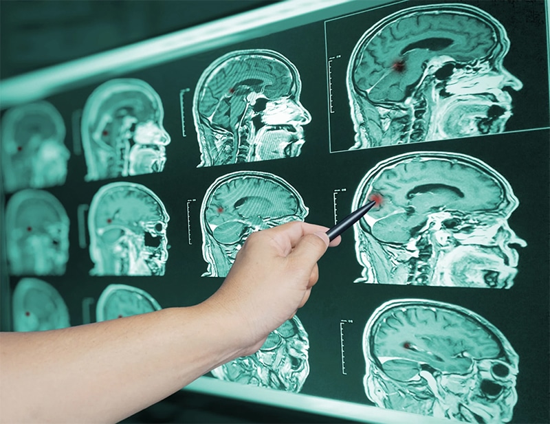 Traumatic Brain Injuries (TBIs)
