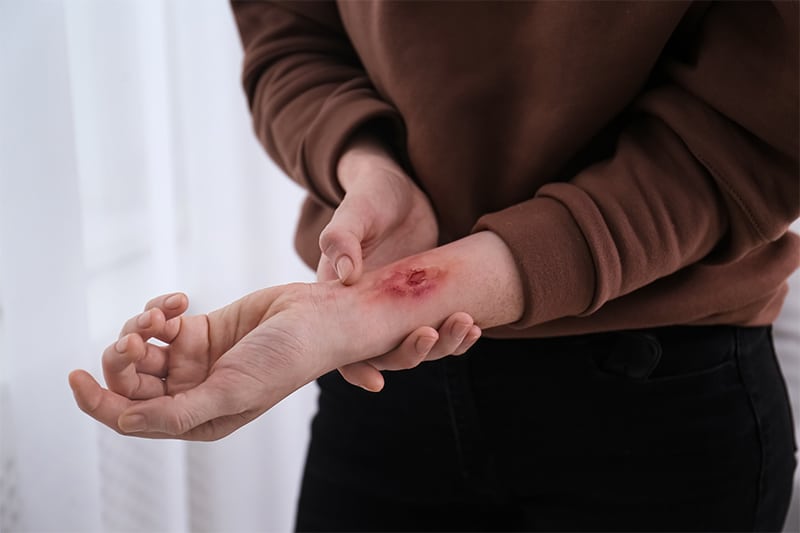 Causes of Burn Injuries​