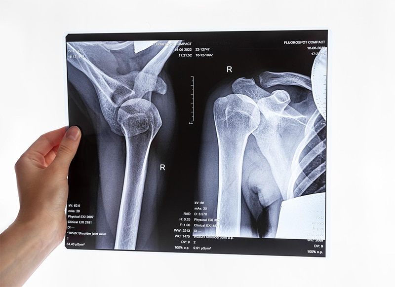 Bone Fractures in the Shoulder Region​