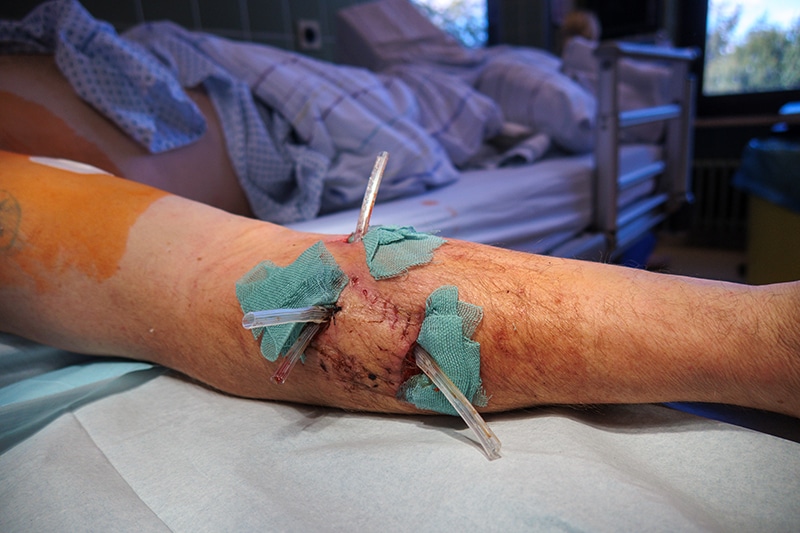 dog bite wound