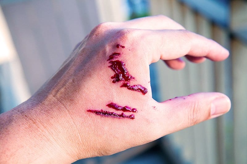 Puncture Wound​