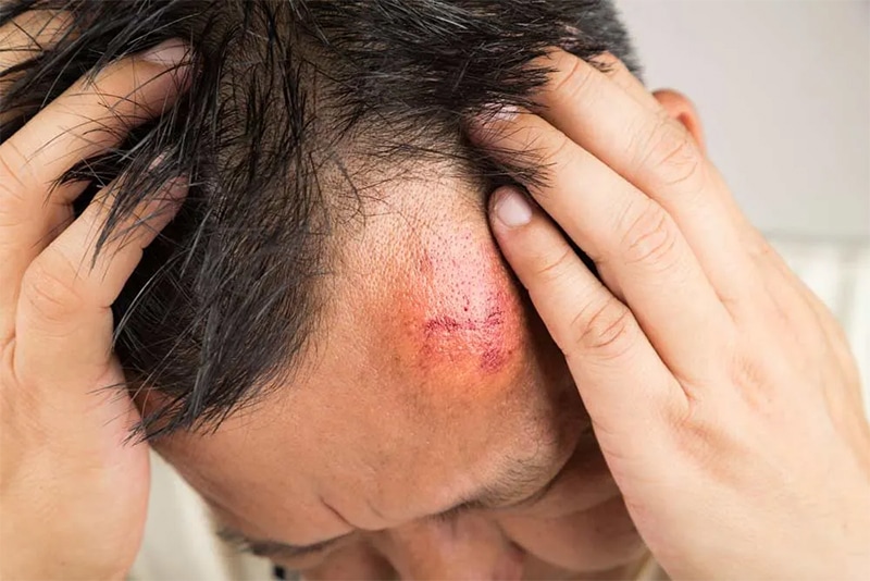Head Injuries:​ Los Angeles
