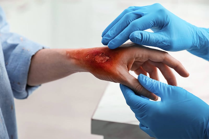 Severe Burns​