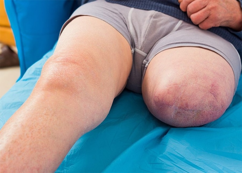 How Can a Maine Amputation Injury Attorney Help Me?