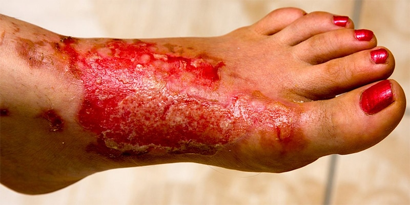 foot with severe burn