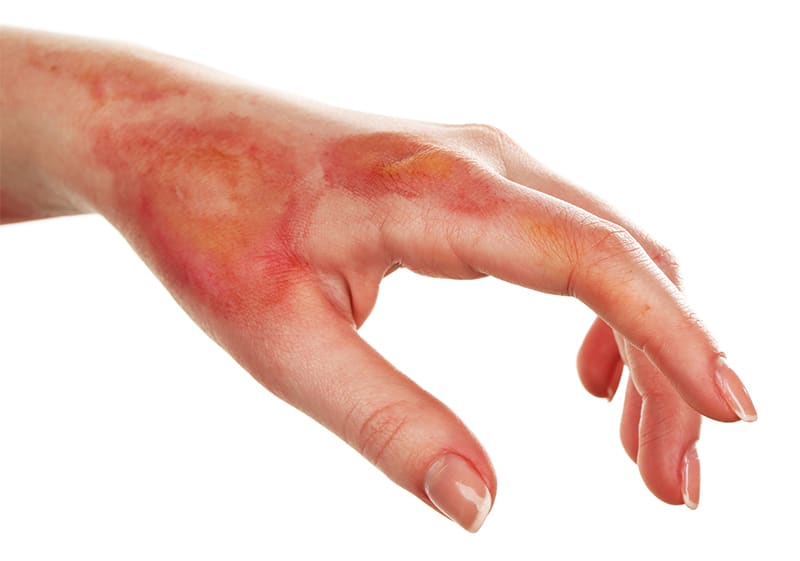 Degrees of Burns