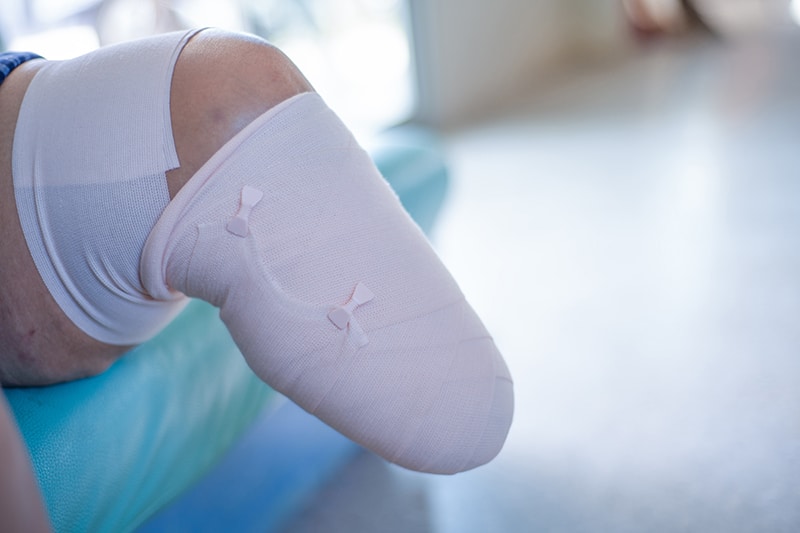 What is an Amputation Injury?