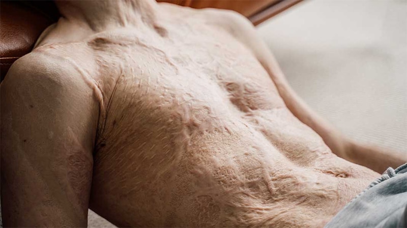 Compensation For Burn Victims