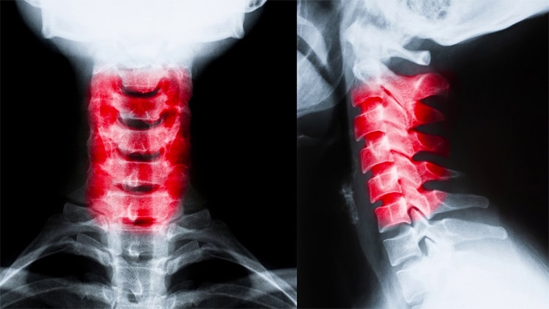 What Compensation Can I Receive for a Neck Injury in Portland, Maine?