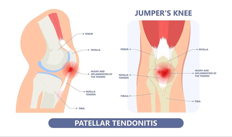Injuries to the Cartilage and Ligaments