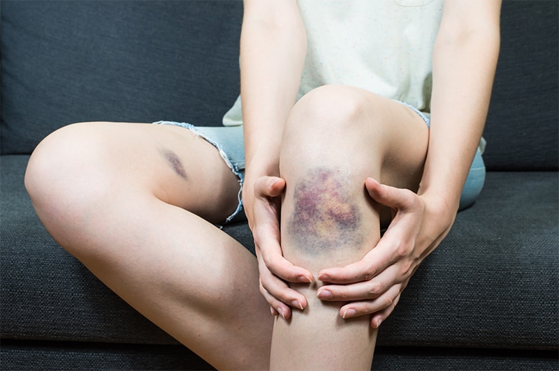 Contusions or Bruises
