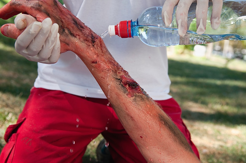 What is a Burn Injury?