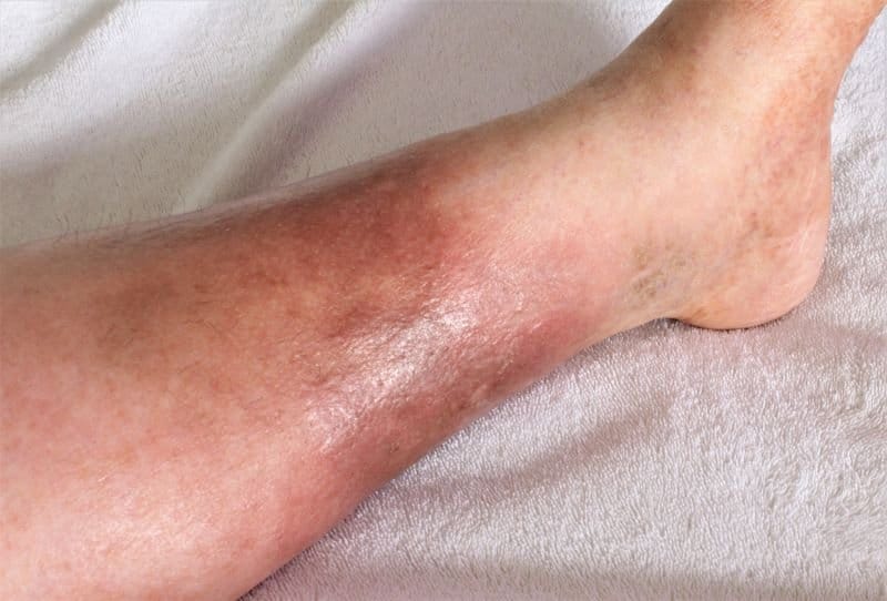 Liability from an Infection in Portland Oregon
