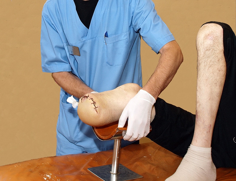 What is an Amputation Injury?