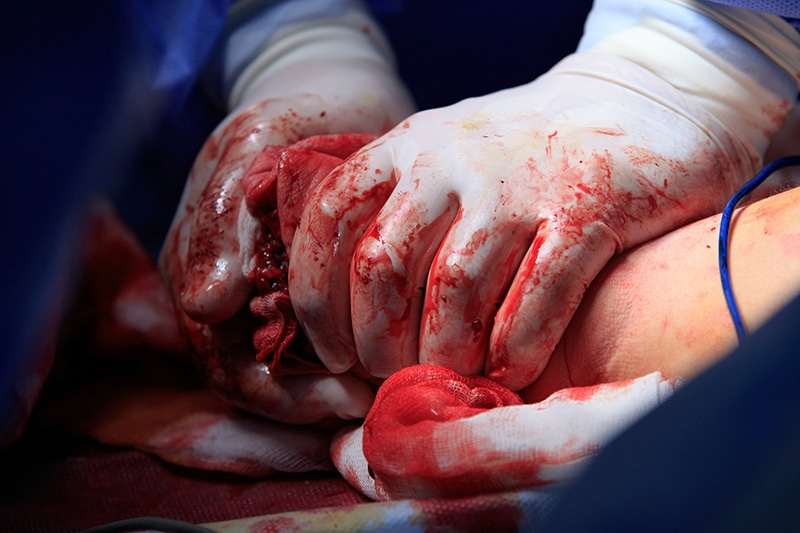 Causes of Amputations