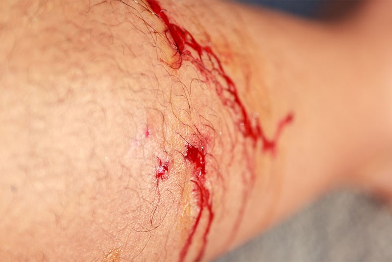 What is a Dog Bite Injury?