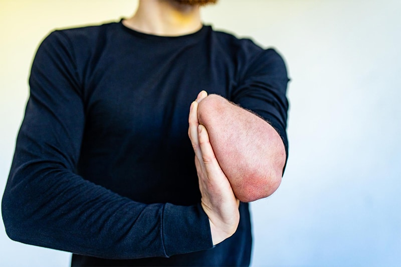 What is an Amputation Injury?