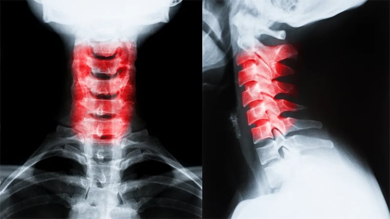 Neck Injuries in Boise