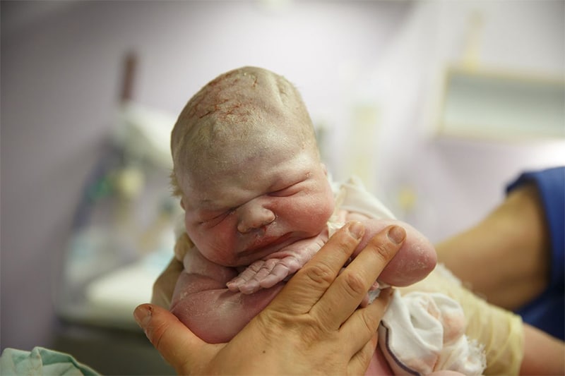 What is a Birth Injury?