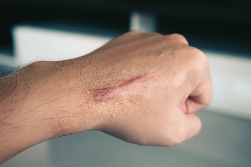 What is Scarring?