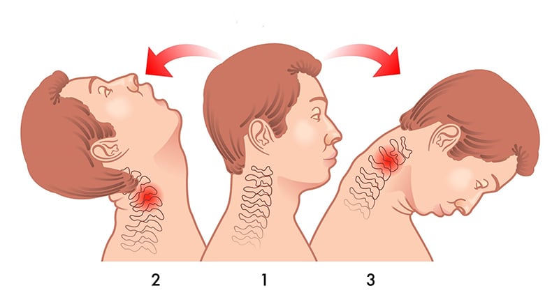 What is Whiplash?