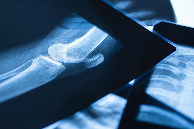 Common Types of Injuries from a Multi-Vehicle Car Accident
