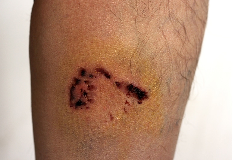 What is a Dog Bite Injury?