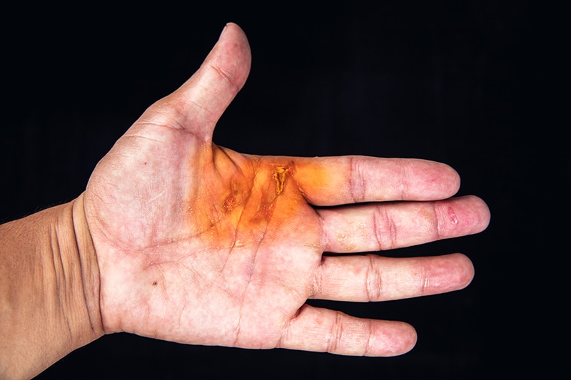 Types of Electric Shock Injuries