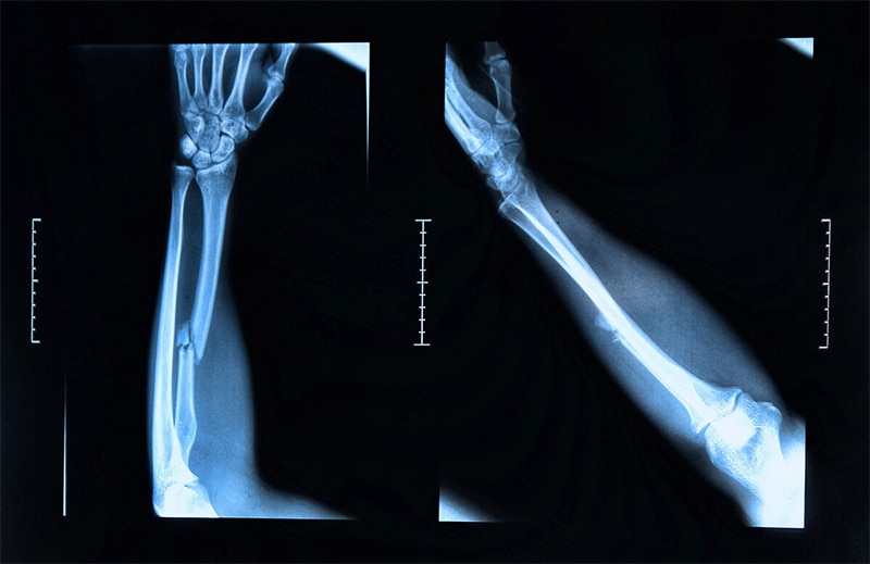 Common Injuries from Truck Accidents