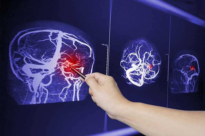 Common Injuries Sustained from T-bone Accidents