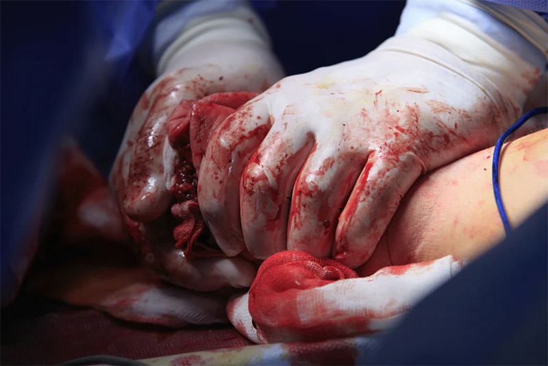 Amputation Injuries