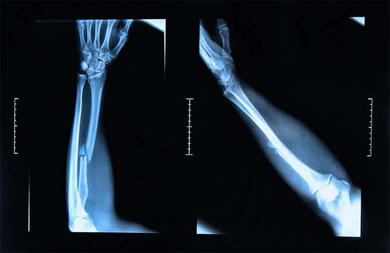 Injuries Sustained Due to Head-on Collisions