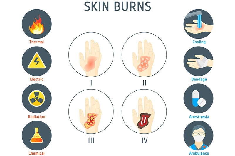 Types of Burn Injuries