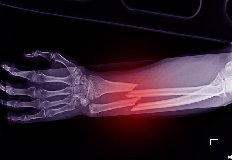 Common Injuries from Electric Scooter Crashes