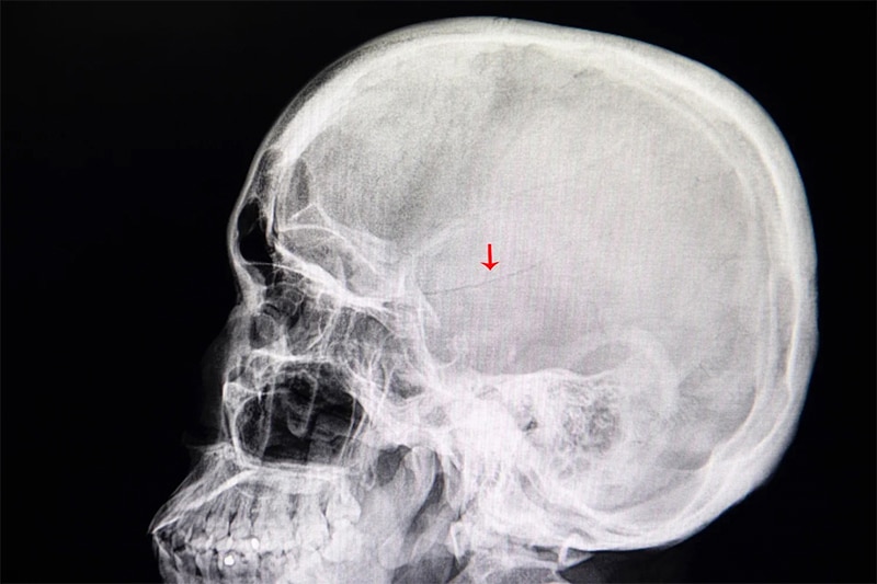 Common Injuries from a Slip-and-Fall Accident