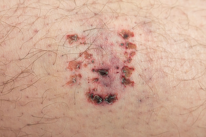 Common Injuries From Dog Bites