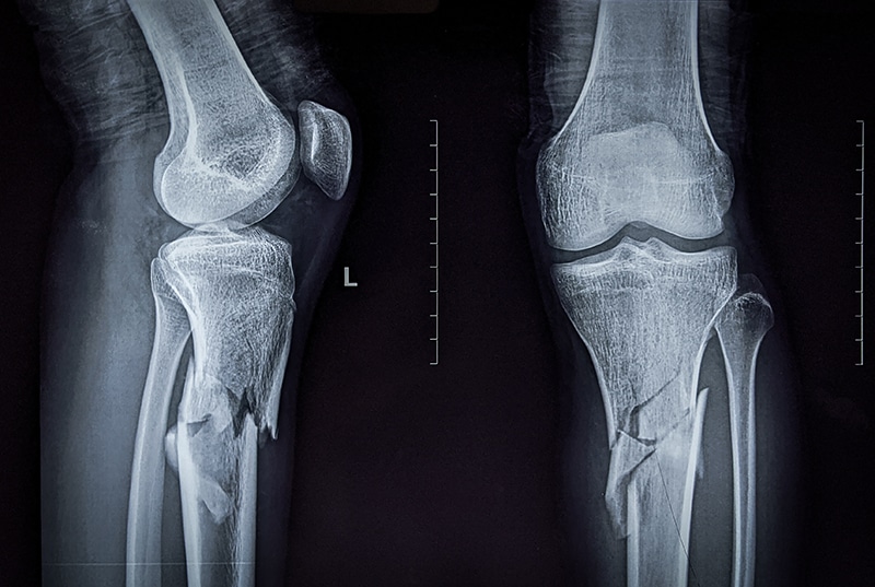 Types of Injuries Sustained in Eugene Bicycle Accidents