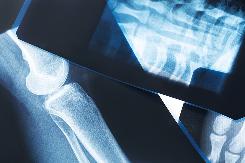 Common Truck Accidents Injuries in Eugene
