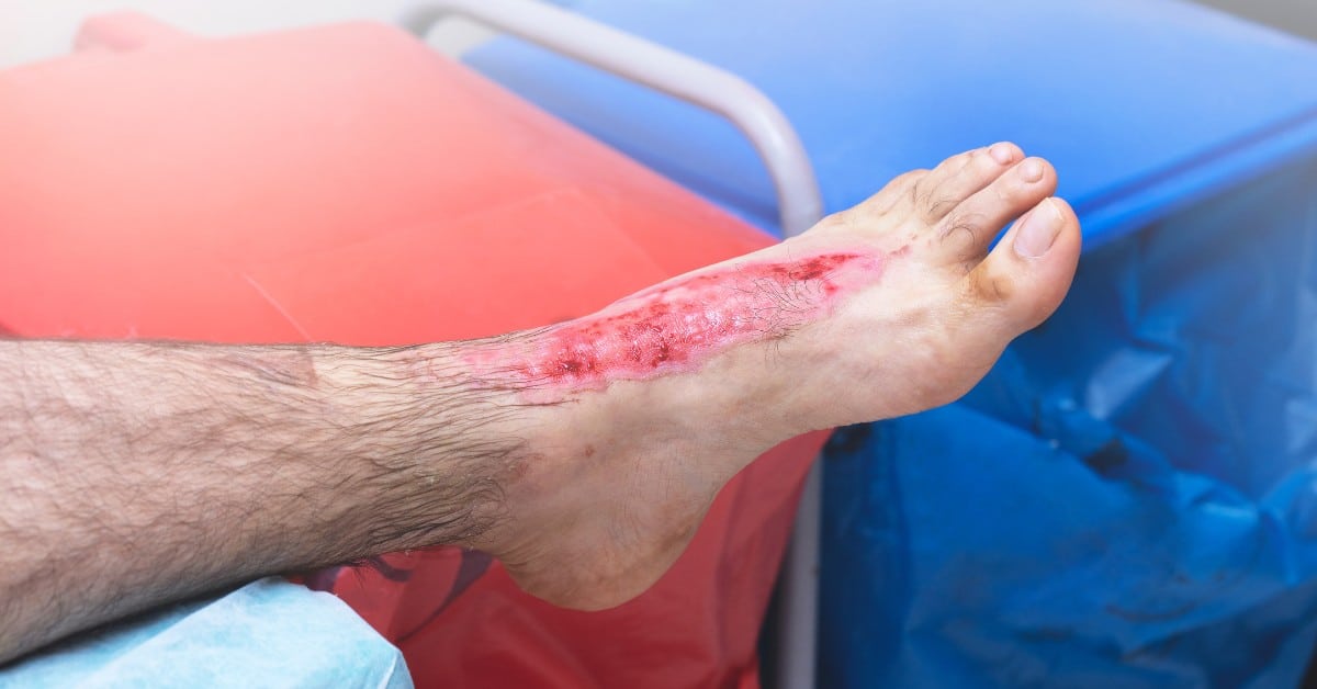 fire injury