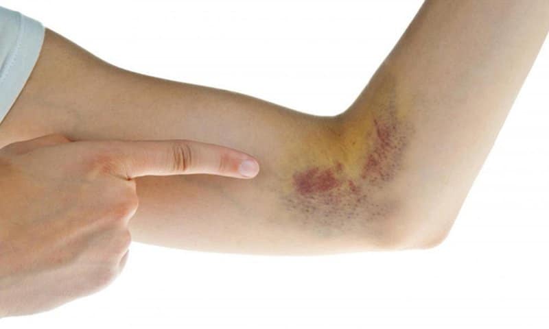 Hematoma