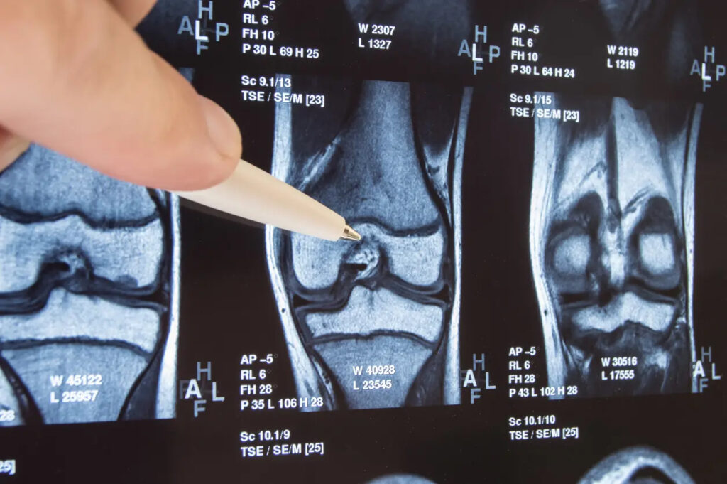 doctor pointing out damage in x-ray of knee.