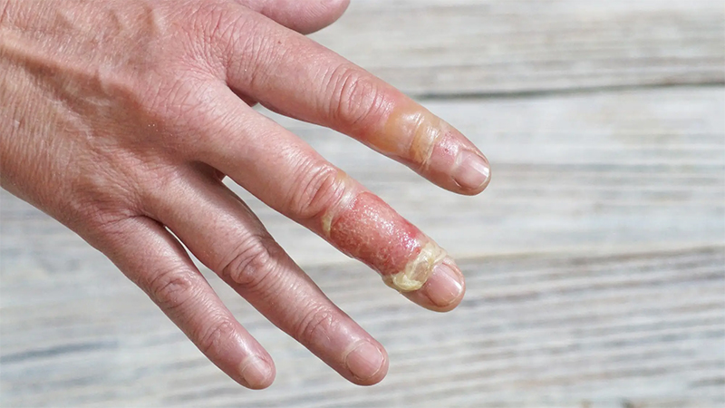 What is a Burn Injury?