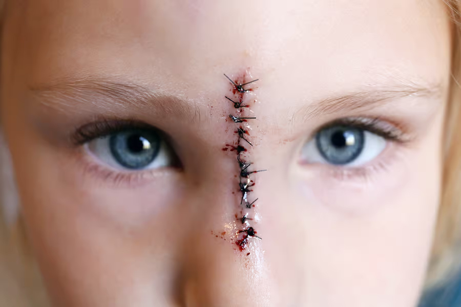child with injury to face